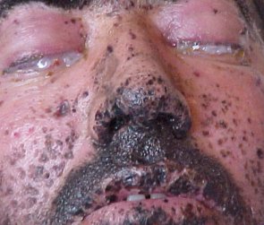 face showing blast damage